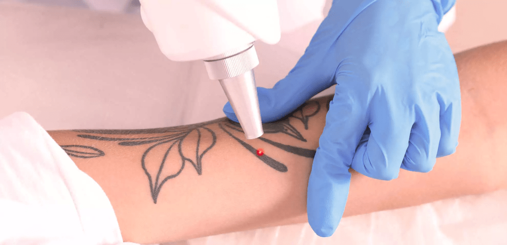 Remoção de Tatuagem
